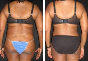 12201-Side2-liposuction - Liposuction - Before And After - Fairfax and Manassas VA