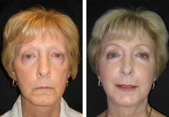12219-front527114f0820fb-non-surgical-facelift - Non-Surgical Facelift - Patient 8 - Before & After 1 | Fairfax and Manassas, VA