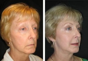 12219-side527114f0dce29-non-surgical-facelift - Non-Surgical Facelift - Patient 8 - Before & After 2 | Fairfax and Manassas, VA