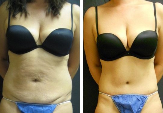 12342-Front-tummy-tuck-abdominoplasty - Tummy Tuck & Abdominoplasty - Before And After - Fairfax and Manassas VA