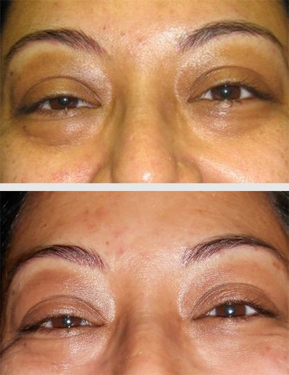 12404-restylane-restylane - Restylane - Before And After | Fairfax and Manassas VA