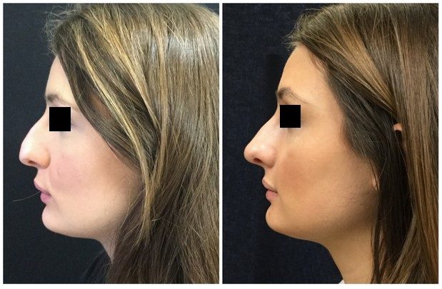 12434a-non-surgical-rhinoplasty - Non-Surgical Rhinoplasty - Before And After | Fairfax and Manassas VA