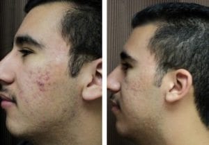 Skin Care Peels - Before And After | Fairfax and Manassas VA