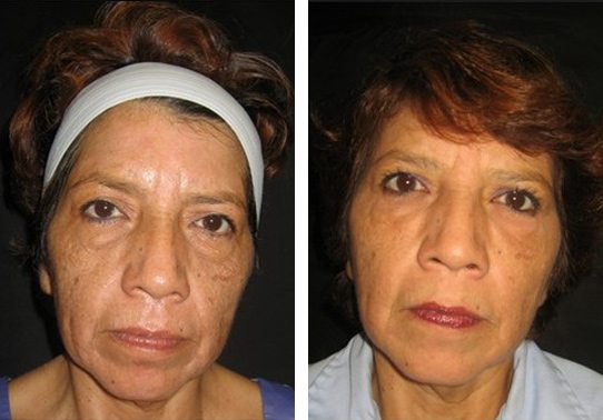12653-front527114f145851-non-surgical-facelift - Non-Surgical Facelift - Patient 9 - Before & After 1 | Fairfax and Manassas, VA