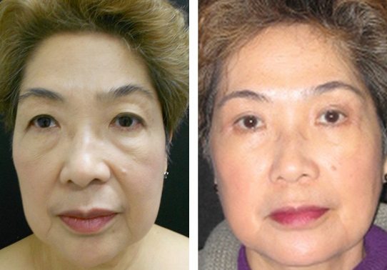 12663-eyelid-lift-upper-and-lower - Upper and Lower Eyelid Lift - Before And After - Fairfax and Manassas VA
