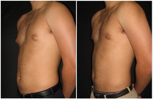 12678a-male-breast-reduction - Male Breast Reduction - Before And After - Gynecomastia - Fairfax and Manassas VA