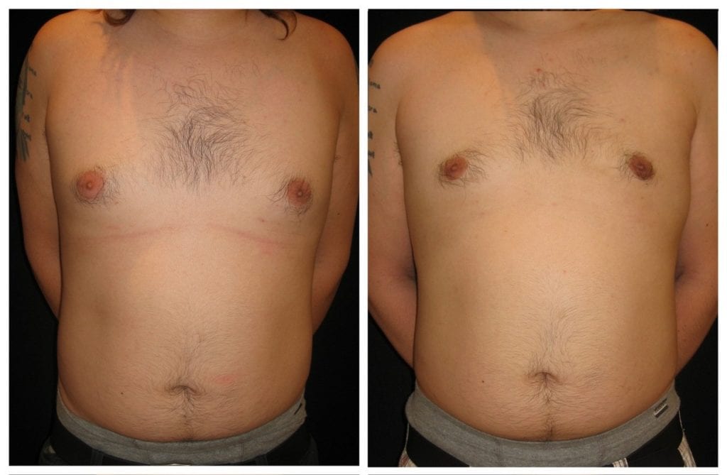 12713a-male-breast-reduction - Male Breast Reduction - Before And After - Gynecomastia - Fairfax and Manassas VA