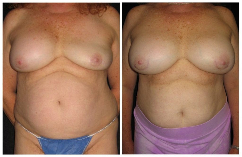 1276a-breast-implant-exchange - Breast Implant Exchange - Before And After - Fairfax and Manassas VA