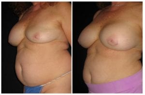 1276b-breast-implant-exchange - Breast Implant Exchange - Before And After - Fairfax and Manassas VA