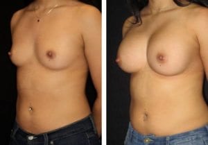 12773-Side-breast-augmentation - Breast Augmentation Before And After - Fairfax and Manassas VA