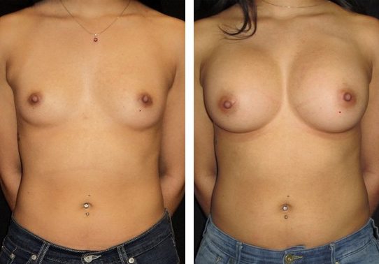 12773Front-breast-augmentation - Breast Augmentation Before And After - Fairfax and Manassas VA