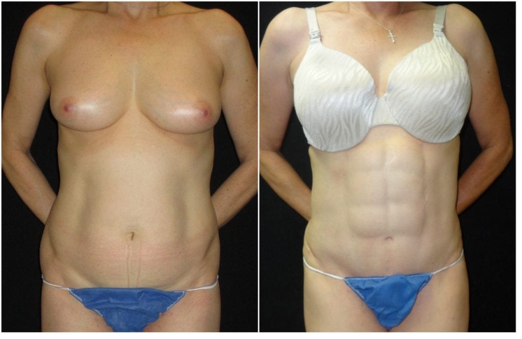 12825a-abdominal-etching - Abdominal Etching - Before And After - Fairfax and Manassas VA