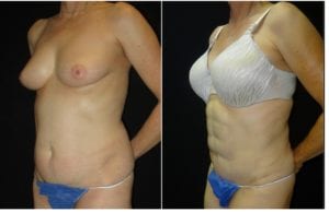 12825b-abdominal-etching - Abdominal Etching - Before And After - Fairfax and Manassas VA