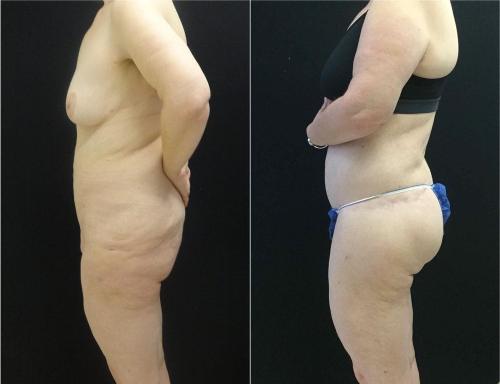 1285-20170607_Canvas-Side-Buttocks-after-weight-loss - Buttock Augmentation - Before And After | Fairfax and Manassas VA