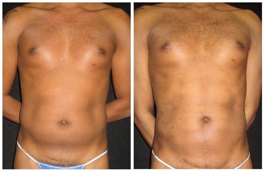 12960a-abdominal-etching - Abdominal Etching - Before And After - Fairfax and Manassas VA