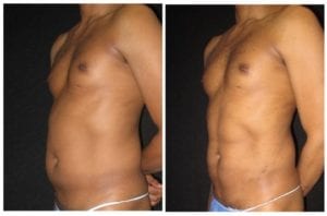 12960b-abdominal-etching - Abdominal Etching - Before And After - Fairfax and Manassas VA