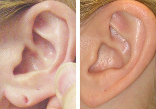 13-torn-earlobe-repair - Torn Earlobe Repair - Before And After | Fairfax and Manassas VA