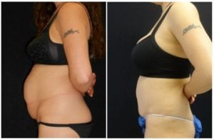 13089b-tummy-tuck-abdominoplasty - Tummy Tuck - Before And After - Abdominoplasty - Fairfax and Manassas VA