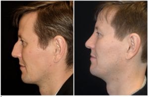 13290-2c-rhinoplasty-for-men - Rhinoplasty For Men - Before And After | Fairfax and Manassas VA