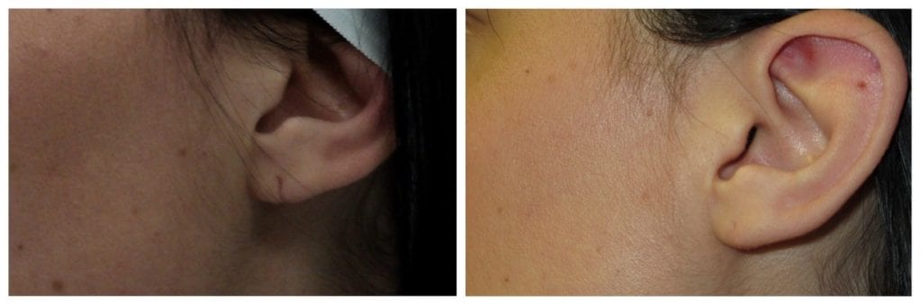 13310-Web1-torn-earlobe-repair - Torn Earlobe Repair - Before And After | Fairfax and Manassas VA