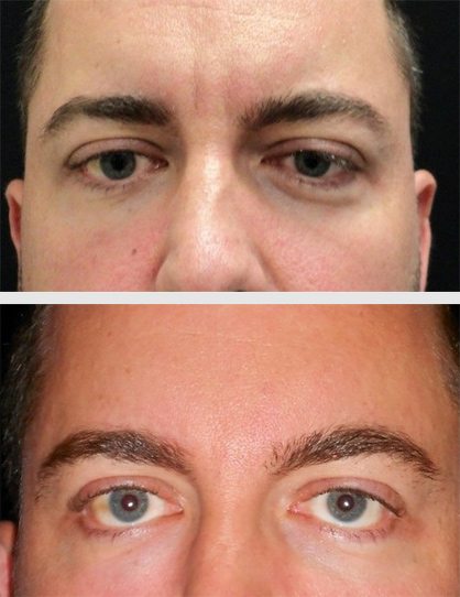 13474-Web-Front-restylane - Restylane - Before And After | Fairfax and Manassas VA