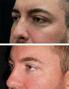 13474-Web-SIde-restylane - Restylane - Before And After | Fairfax and Manassas VA