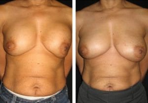 Breast Implant Exchange - Before And After - Fairfax and Manassas VA
