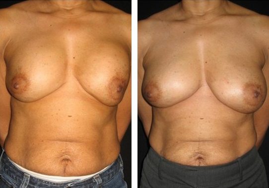 13493-Front-breast-implant-exchange - Breast Implant Exchange - Before And After - Fairfax and Manassas VA