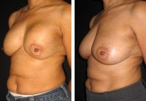 13493-Side-breast-implant-exchange - Breast Implant Exchange - Before And After - Fairfax and Manassas VA