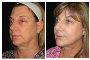 13570a52e8c601ef7d6-necklift - Neck Lift - Before And After | Fairfax and Manassas VA