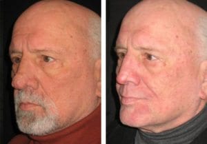 13646_b5271242a8d5e4-rhinophyma-reduction - Rhinophyma Reduction - Before And After | Fairfax and Manassas VA