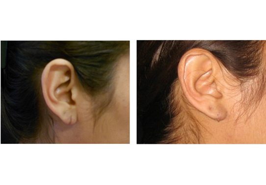 13735a-torn-earlobe-repair - Torn Earlobe Repair - Before And After | Fairfax and Manassas VA