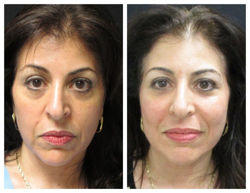 13876a-fat-grafting - Fat Grafting - Before And After - Fairfax and Manassas VA