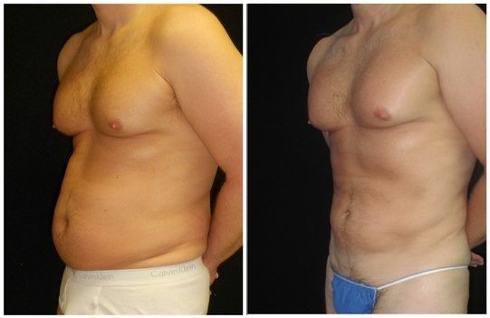 13887a-liposuction - Liposuction - Before And After - Fairfax and Manassas VA