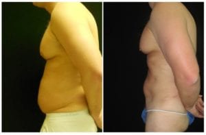 13887b-liposuction - Liposuction - Before And After - Fairfax and Manassas VA