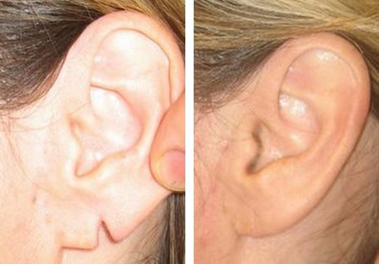 14-torn-earlobe-repair - Torn Earlobe Repair - Before And After | Fairfax and Manassas VA