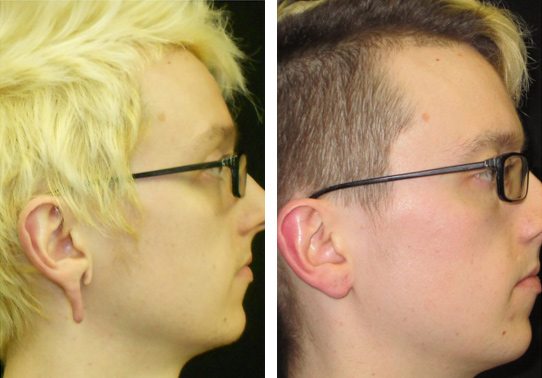 14131-torn-earlobe-repair - Torn Earlobe Repair - Before And After | Fairfax and Manassas VA