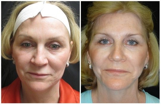 14313a-facelift - Facelift - Before And After Photos - Fairfax and Manassas VA