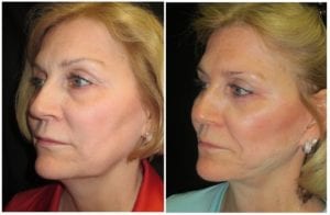14313b-facelift - Facelift - Before And After Photos - Fairfax and Manassas VA