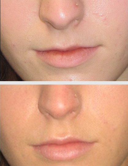 14464a-restylane - Restylane - Before And After | Fairfax and Manassas VA