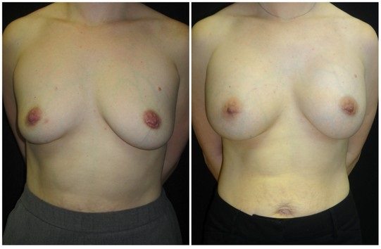 14607a-breast-augmentation - Breast Augmentation Before And After - Fairfax and Manassas VA