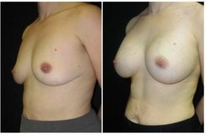 14607b-breast-augmentation - Breast Augmentation Before And After - Fairfax and Manassas VA