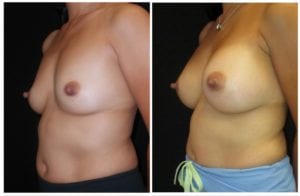 14833B-breast-augmentation - Breast Augmentation Before And After - Fairfax and Manassas VA