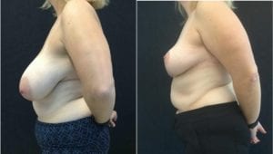 15112-20170517_Canvas25942c4170091f-breast-reduction - Breast Reduction Before And After - Fairfax and Manassas VA