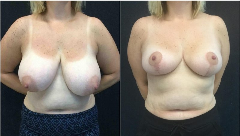 15112-20170517_Canvas5942c416664e9-breast-reduction - Breast Reduction Before And After - Fairfax and Manassas VA