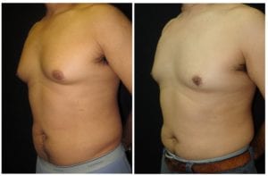 15264b-male-breast-reduction - Male Breast Reduction - Before And After - Gynecomastia - Fairfax and Manassas VA