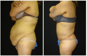 15266d545c2dd463730-after-weight-loss - After Weight Loss - Patient 2 - Before & After 3 | Fairfax and Manassas, VA