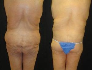 15287-20170605_Back-Canvas-lower-body-lift - Lower Body Lift - Before And After - Fairfax and Manassas VA