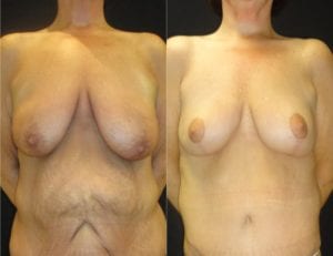 15287-20170605_Breast-Aug-Canvas-breast-lift - Breast Lift - Mastopexy Before And After - Fairfax and Manassas VA