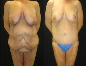 Lower Body Lift - Before And After - Fairfax and Manassas VA